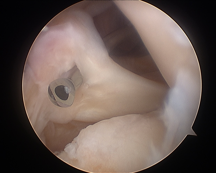 Meniscal Root Repair 3